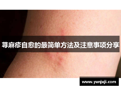 荨麻疹自愈的最简单方法及注意事项分享